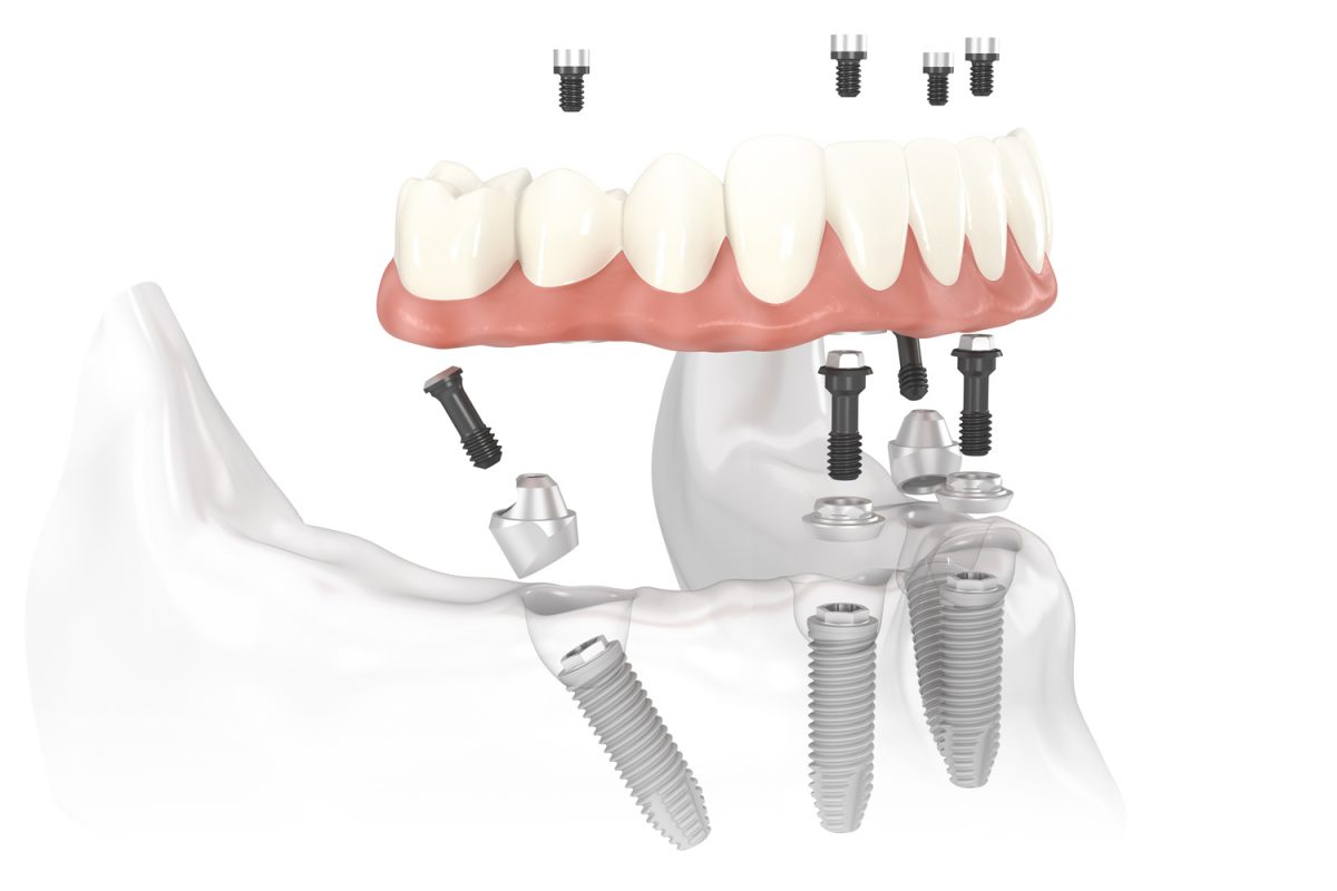 mất răng trồng implant