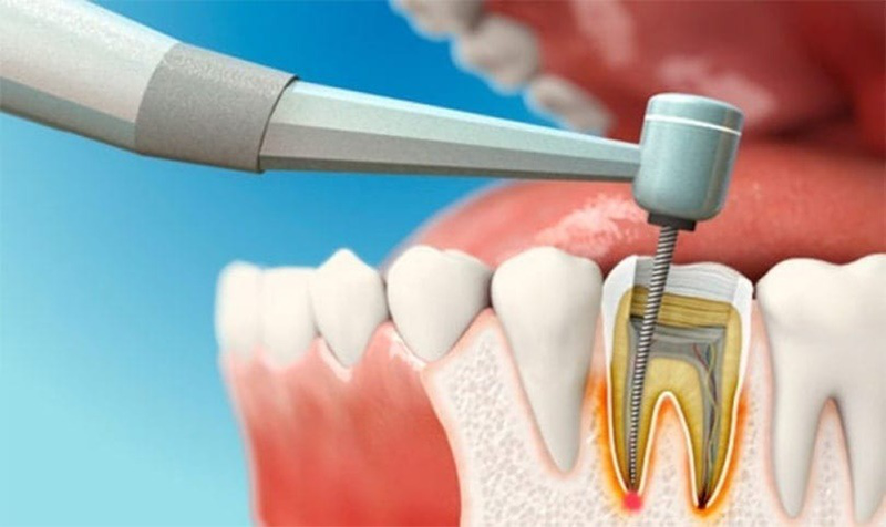 lấy tủy răng đau không
