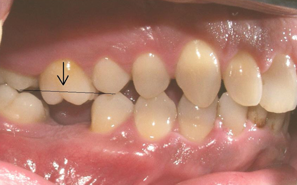 mất răng hậu quả