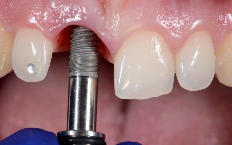 trồng răng implant