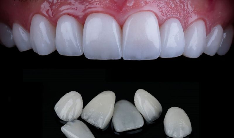 dán veneer Lisi Ultrathin