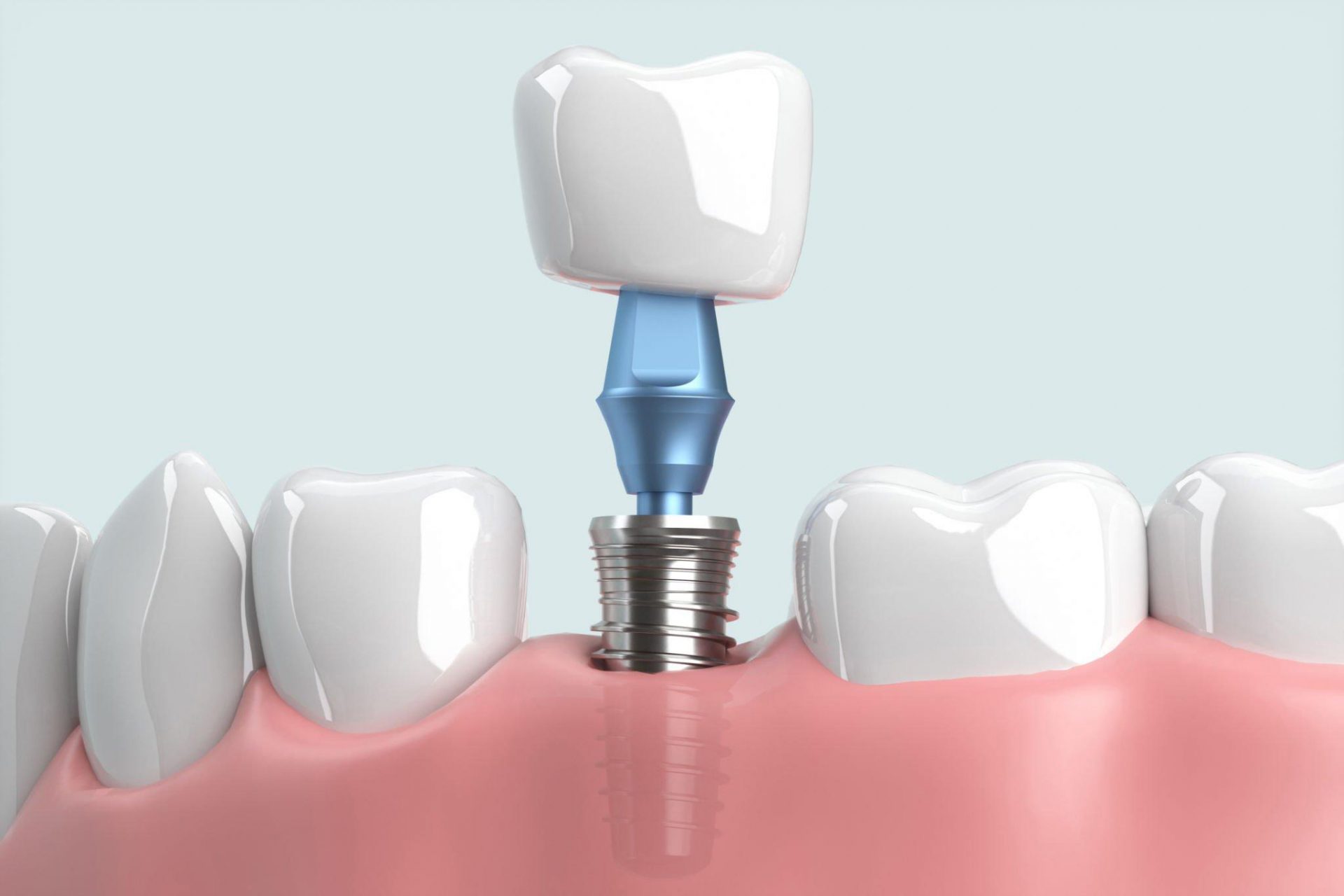 trồng răng implant