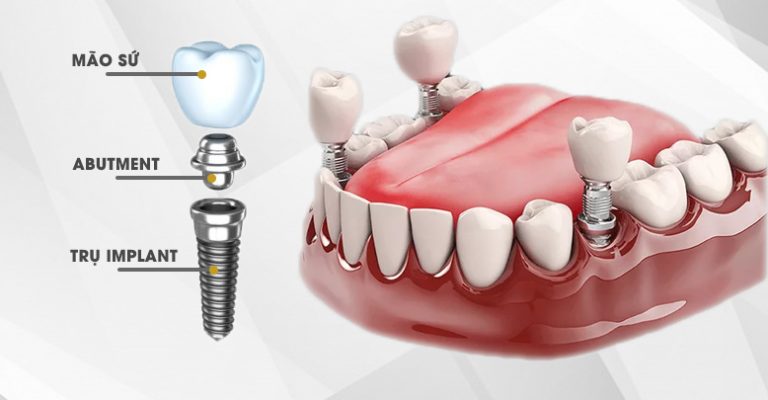 Trụ implant Hàn Quốc