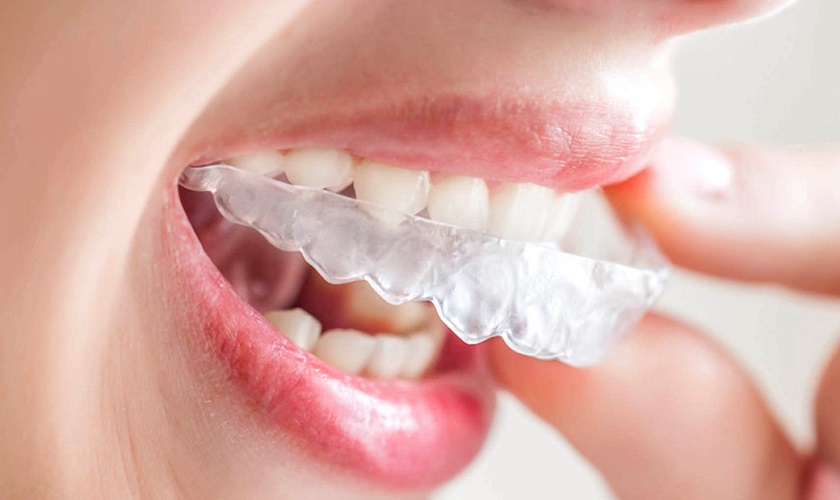 khay niềng ivisalign